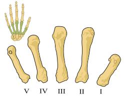 1 st Metacarpal bone Presence of