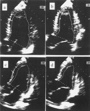 elite rower These ultrasound images show the hypertrophied but geometrically similar heart of an elite Italian rower compared to the smaller heart of an untrained subject.