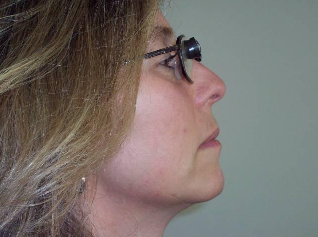 Photo No. 2: A lateral view of a person looking through a Designs For Vision, Inc. (DVI) 2.