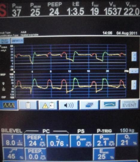 Careful observation of the T H and T L is warranted when the patient is spontaneously breathing Some ventilators will alter the set times to synchronize the pressure changes
