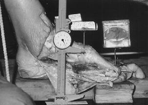 First Ray First Ray dorsiflexion preceeds MTJ supination about longt. axis. First Ray dorsiflexes and inverts.