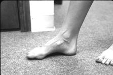 B, Reference and corrective platforms for intrinsic balancing of the positive cast.