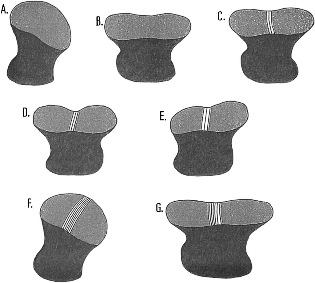HARLING: EYE DESIGN IN STOMATOPOD CRUSTACEANS 183 Fig. 5. The seven eye types in stomatopods as typified by: A, Type 1 Cornea globular, midband absent, e.g., Bathysquilla crassispinosa; B, Type 2 Cornea bilobed, midband absent, e.