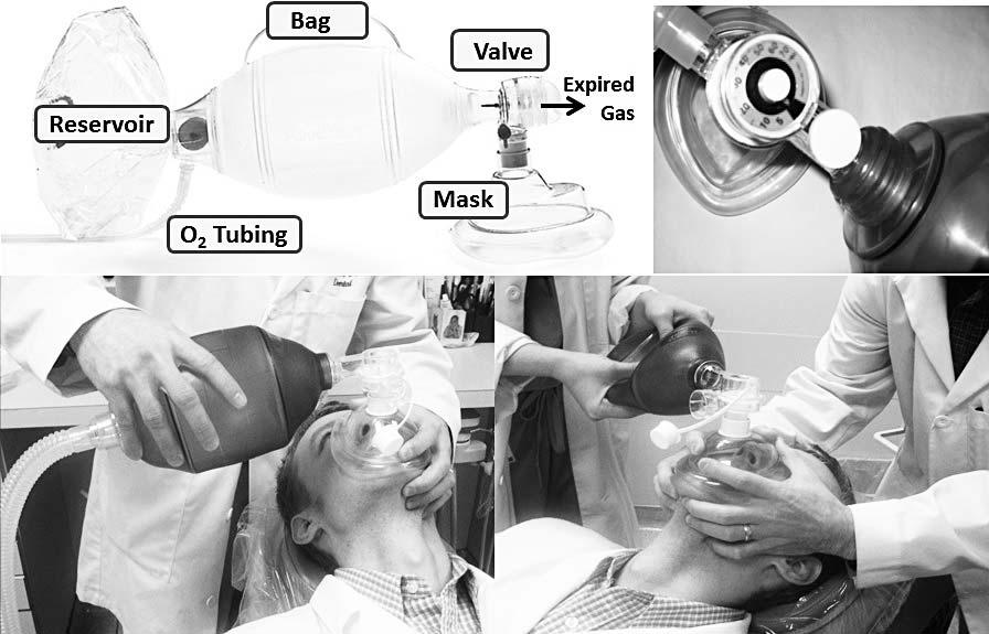Anesth Prog 61:78 83 2014 Becker et al. 81 Figure 3. Bag-valve-mask with reservoir.