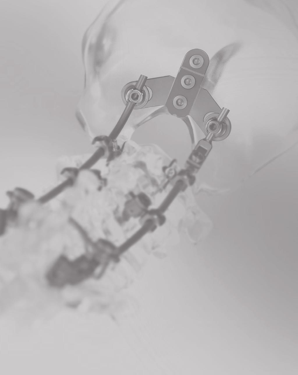 DePuy Spine has collaborated with the surgeon community to drive procedural enhancements through implant and instrument UNPARALLELED FIXATION OPTIONS innovation.