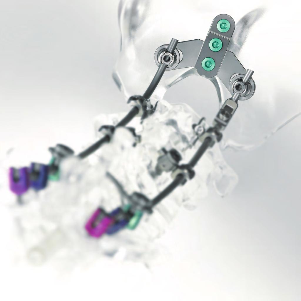 DePuy Spine is committed to collaborating with surgeons to continue driving procedural Product 2000 SUMMIT Minipolyaxial s Tumors The Occipital Bone s are limited to occipital fixation only.