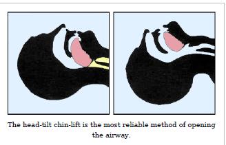 First aid practice(st John Ambulance Service) The simplest way of ensuring an open airway in an unconscious patient is to use a head tilt chin lift technique, thereby lifting the tongue from the back