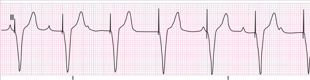 initially presented with dizziness, shortness of breath, and heart rate of 40 BPM.