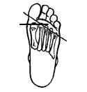 iomechanical foot function: a Podiatric perspective In 1979, ojsen-moller described how the metatarsal axes would effect foot function.