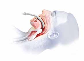 LMA Flexible : truly flexible Designed for shared airways airway tube can be moved out of the surgical field without displacement of the cuff, or loss of seal for the anaesthetist Improved recovery