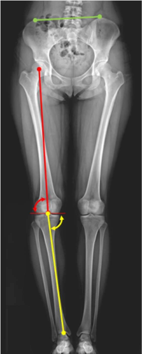 KJSB Effect of Taping Therapy and Inner Arch Support on Plantar Lower Body Alignment and Gait 233 Table 7. Guide line for radiography Lower leg Foot Guide line Table 8.