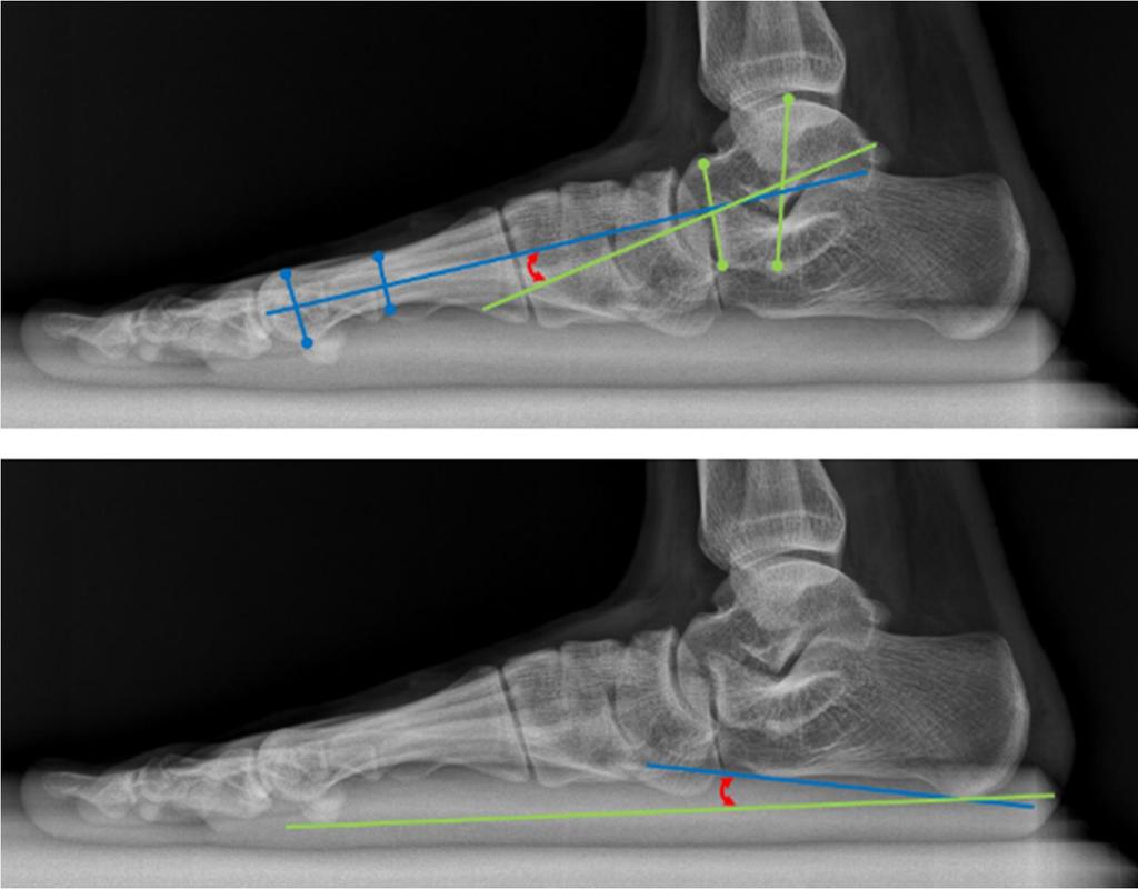 weight-bearing posture angle of horizon Femur-to -medial point of the patella: The angle of the connecting line of the tibia Center point of the patella: The angle formed by the connecting line at