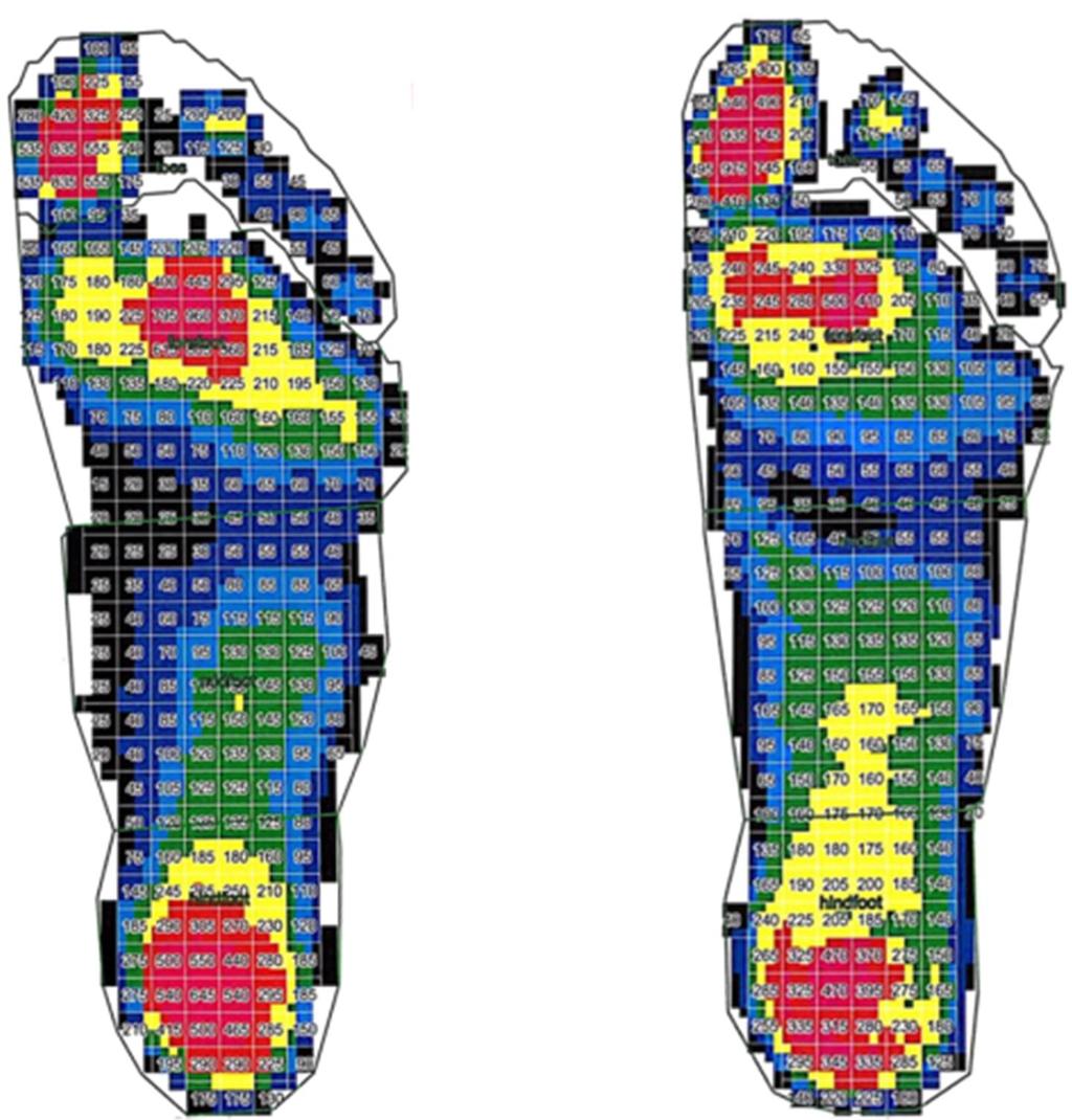 KJSB Effect of Taping Therapy and Inner Arch Support on Plantar Lower Body Alignment and Gait 235 Table 12. Lower body angle (Unit: ) S1 13 86.77 ± 2.13 S2 13 87.08 ± 1.61 -.718.