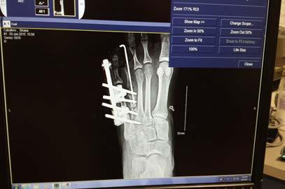 - One of the pins went through the top of my fourth toe and into the bone (to keep it in place).