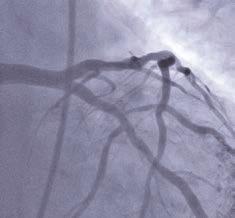 circumflex artery (CX) and its posterolateral branch (PL-CX) Procedure:
