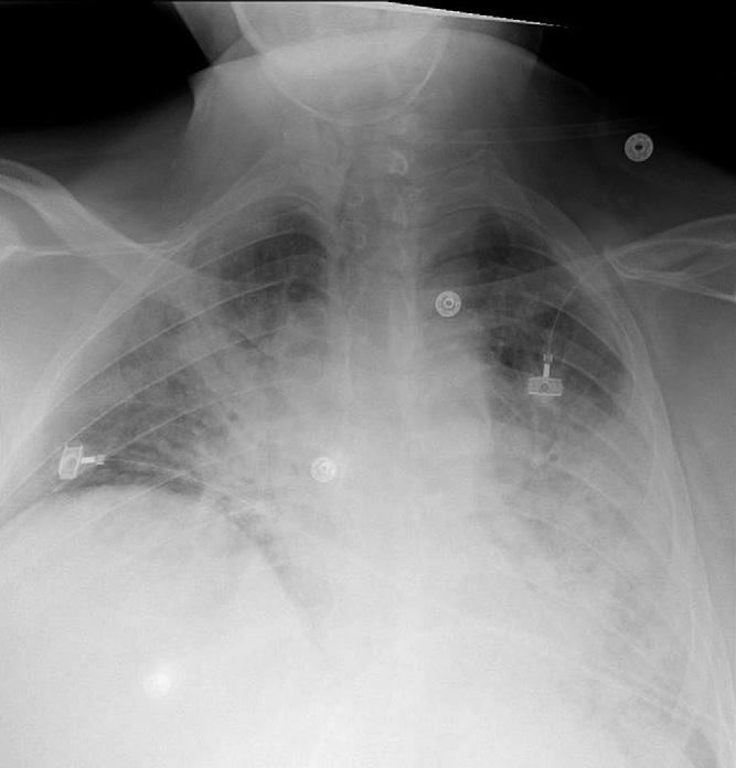 Figure 2. Portable chest radiograph of patient 2. administered through a face mask with FI O2.35 for patient 1 to achieve an Sp O2 of roughly 94%.