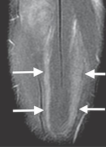 For example, mild and incomplete lesions may appear merely as edema along the interface Fig. 6 22-year-old male soccer player with injury to rectus femoris muscle.