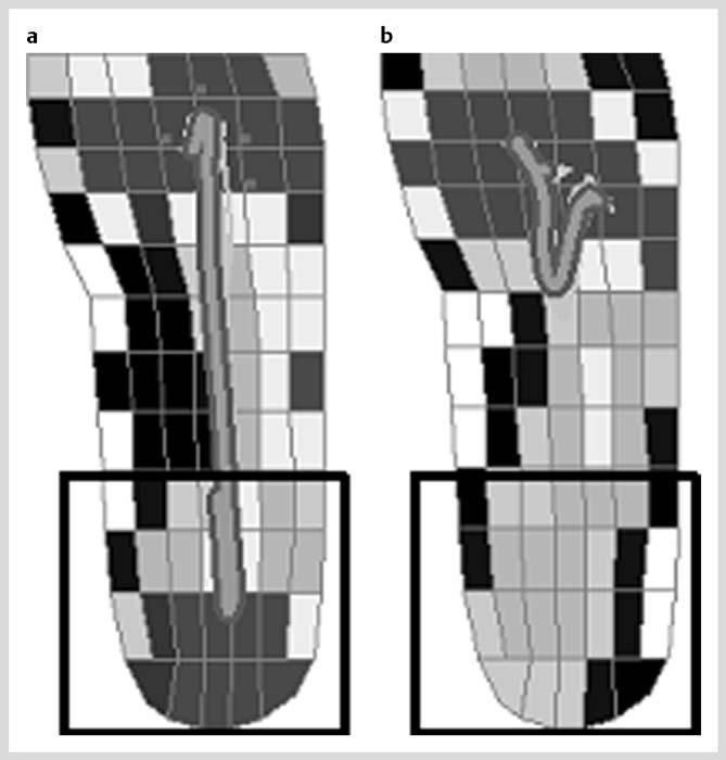 Orthopedics & Biomechanics 3 3 4 5 2 Fig. 2 Each runner s foot strike index was defined based on the average center of pressure (COP) location of 30 foot strikes during treadmill running.