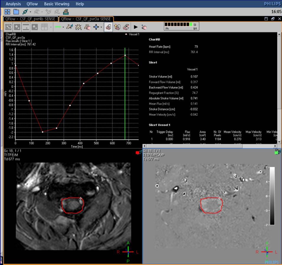 Image Analysis On all axial slices, thecal sac was