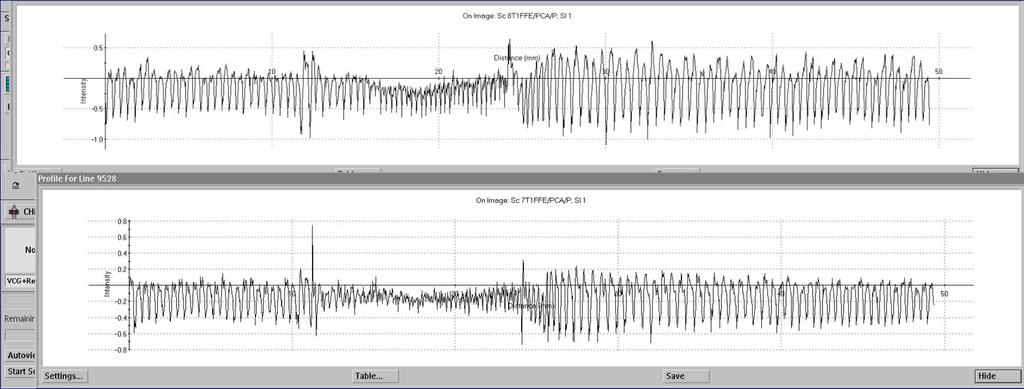 Correlation between Pressure and Flow Studies CSF