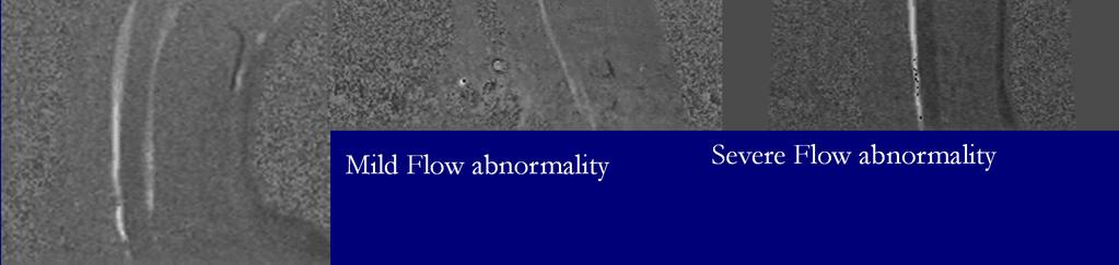 Mild Flow abnormality