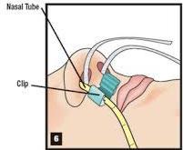 Background Information The AMT Bridle Nasal Tube Retaining System is a product used in healthcare facilities worldwide to reduce the risk of inadvertent nasal feeding tube pullouts.