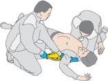 4) Remove the Backboard (B) and place it under the patient s back just below the axillae level, to permit the plunger to be placed at