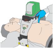 6) Position the suction cup over the chest, using two fingers, and with the device in the adjust mode (button 1).