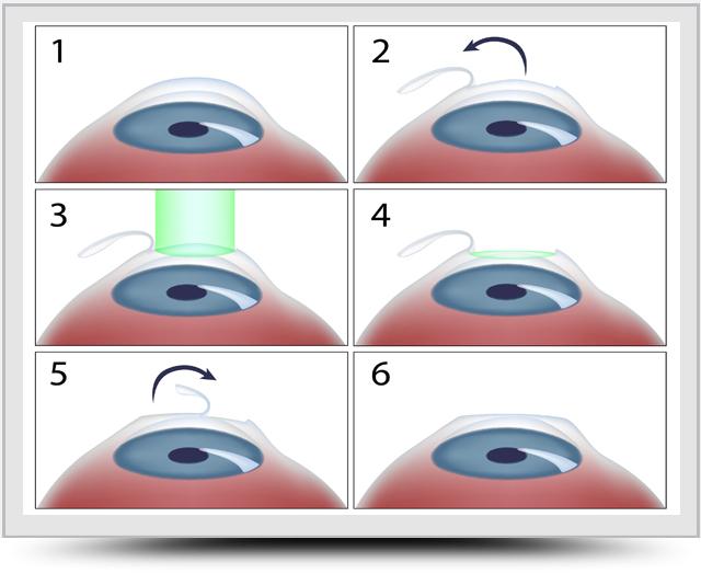 Femto-LASIK Laser-assisted in situ keratomileusis (LASIK) is categorised as flap surgery, where the flap is cut into the stroma directly.