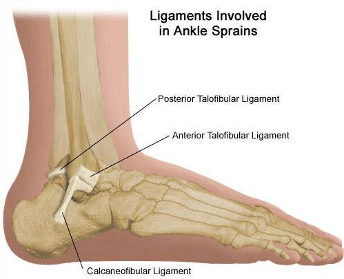 ATF is the most commonly damaged ligament in the lateral ankle sprain [3, 19, 51, 56, 62, 69-74]. Figure 2.
