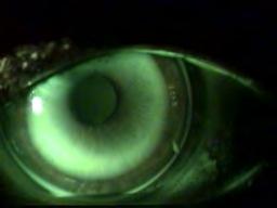 lenses are riding infero-temporally or down & out.