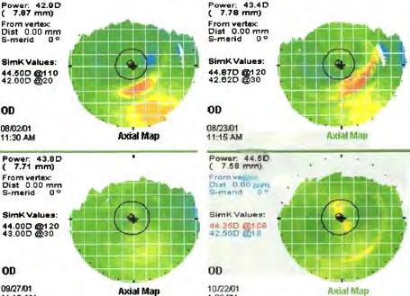 A decentered lens only makes the corneal topography more misshapen if lens parameters remain unchanged (top photos).