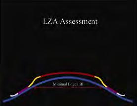 LZA Assessment Significant edge lift may be seen when the LZA has too low an angle and will present with a sealed off periphery when the LZA is too steep.
