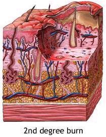 Burns (Cont.) Second-degree burns (Partial Thickness) Epidermis and upper regions of dermis are damaged.