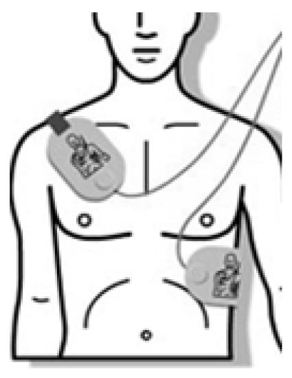 Remove the self-adhesive backing and attach the electrodes to the victim s bare chest.