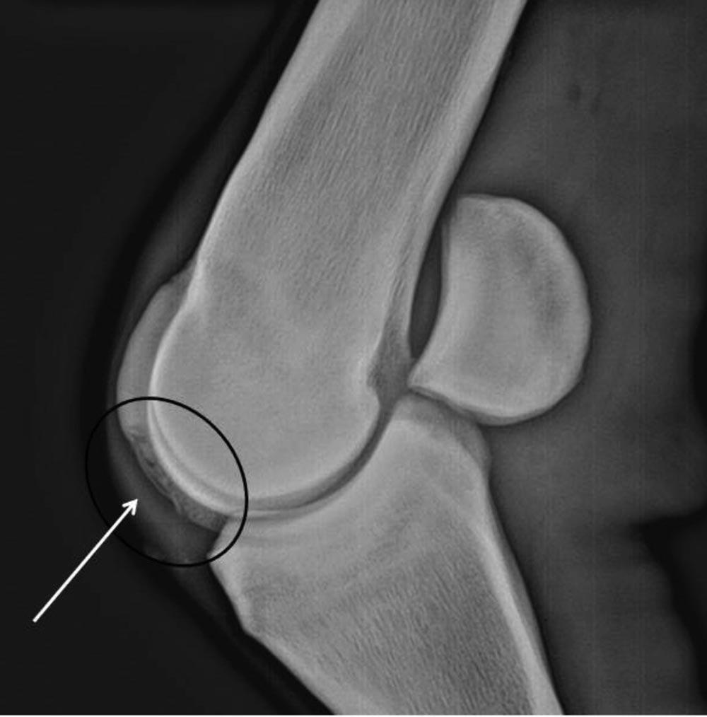 Fig. 3. Fetlock joint flexed lateral to medial projection. This horse has large irregularity in the middle of the sagittal ridge. This radiograph will be discussed by the panel as Case 3. Fig. 4.