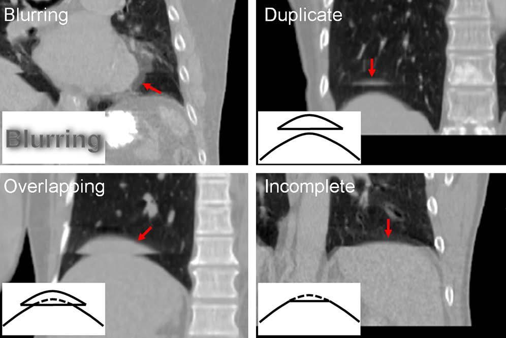 Rationale: Motion Artifacts in 4D CT with irregular motion