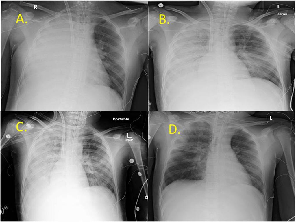 Figure 3. (A) Chest X-ray (CXR) after extracorporeal membrane oxygenation cannulation. (B) CXR immediately before bronchoscopy/endotracheal tube (ETT) change.