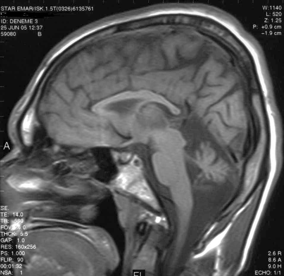 Figure 6 MRI of Subject #11, midline sagittal section. Note reduction of cerebellar vermis, and thinning of corpus callosum.