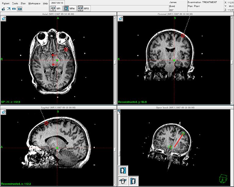 Leksell Stereotactic Neurosurgery Leksell SurgiPlan Leksell SurgiPlan is an advanced image-based neurosurgical planning software, designed for Leksell Stereotactic System.
