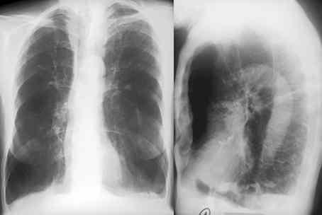 Pulmonary Emphysema abnormal permanent enlargement of the airspaces distal