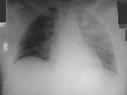 Lung Injury - X-Ray Haemothorax collection of blood in