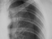 pleural cavity Pneumothorax abnormal collection of air