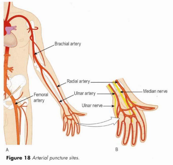 Arterial blood sampling CLSI H11-A4: Procedures for the Collection of Arterial Blood Specimens (2004) Sampling: from radial artery indwelling arterial catethers discomfort