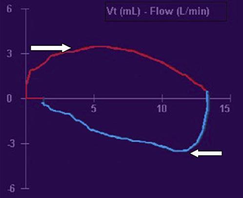 Flow-Volume Loop - Resistance Increased resistance(lower peak inspiratory and expiratory flows) Decreased resistance(higher