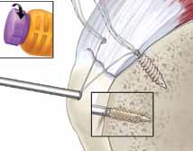 Use a Smith & Nephew ELITE PASS Suture Shuttle to pass sutures through the rotator cuff from an anterior to posterior position, then tension and