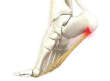 PLANTAR FASCIITIS: THE ARCH ENEMY OF FOOT COMFORT. Good Feet arch supports can alleviate even eliminate the pain. Align the feet. Align the body.