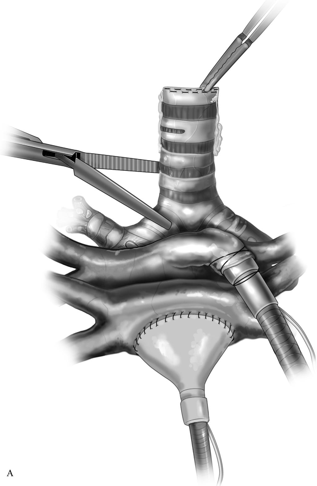 Ex vivo lung perfusion 437 Figure 3