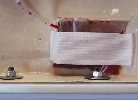 Carefully remove the white cap on the simulated blood reservoir bag, taking care not to let the liquid leak out and attach the female
