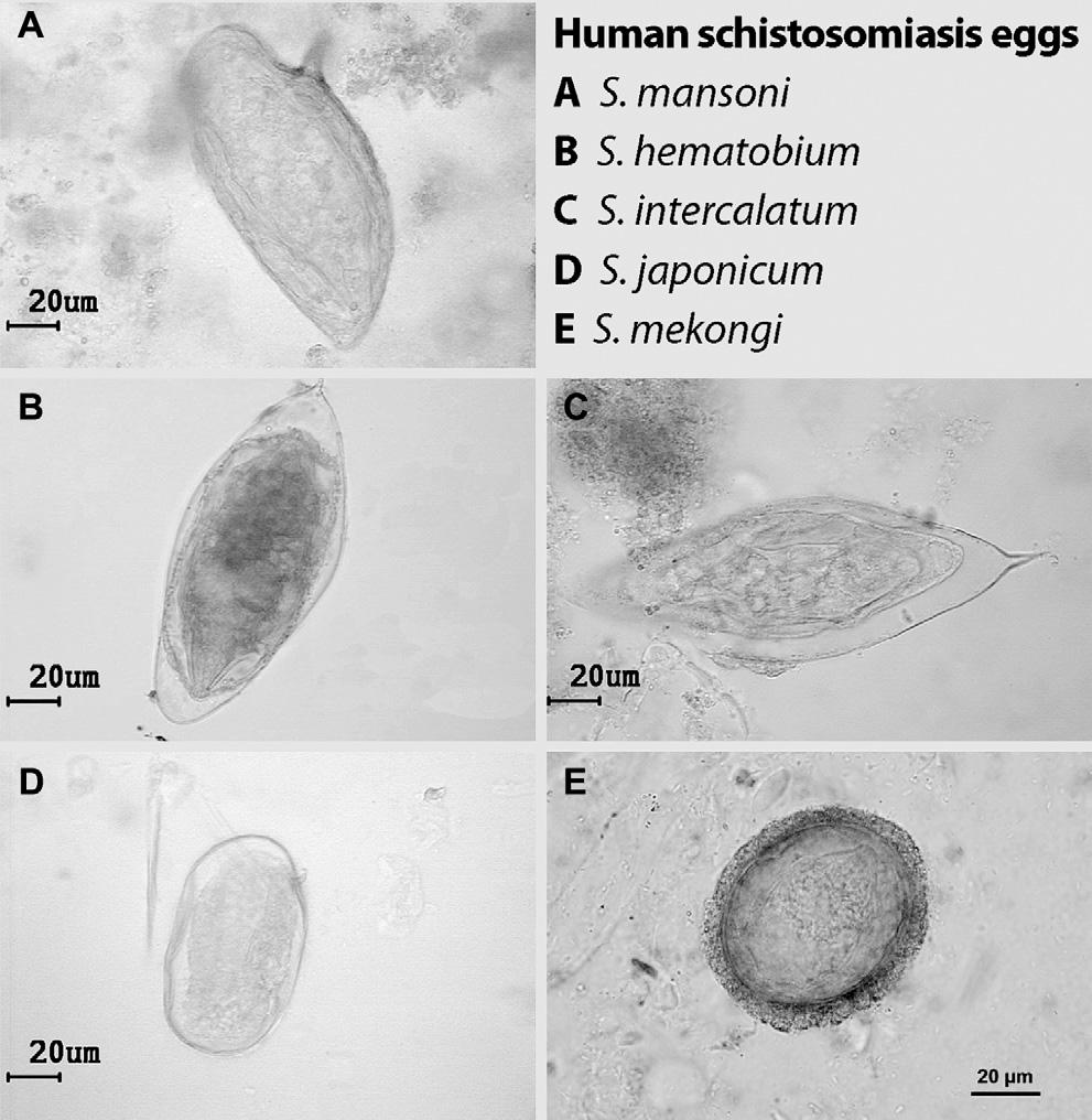 Schistosomiasis in travellers and migrants 15 Figure 4 Egg morphology of human schistosomiasis. polyps mimicking neoplasia.